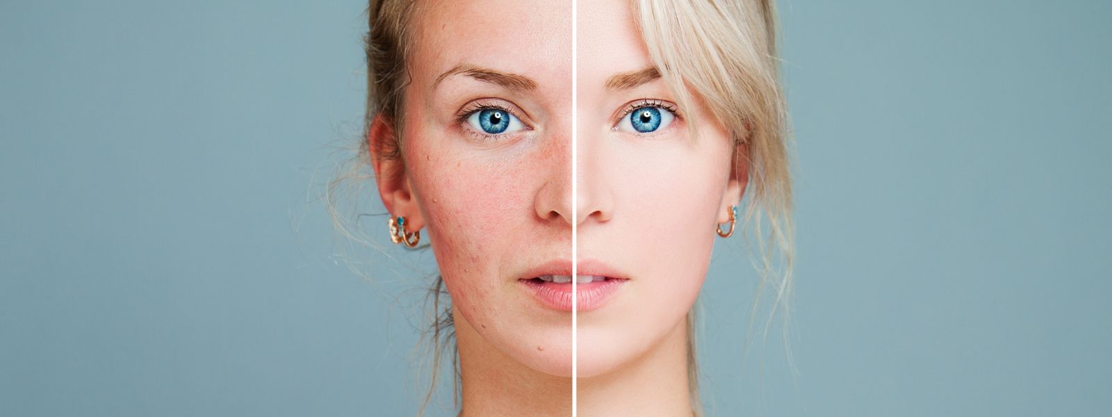 Girl with Rosacea red face and after.